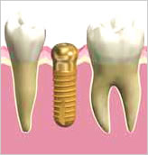 インプラント　植立の手術