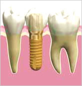 インプラント　人工の歯の取り付け